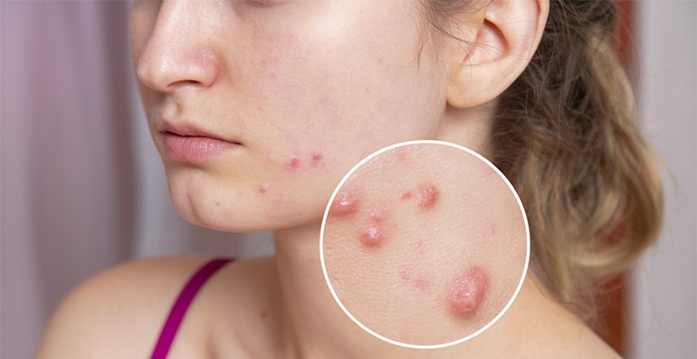 Как да се отървем от акне в домашни условия
